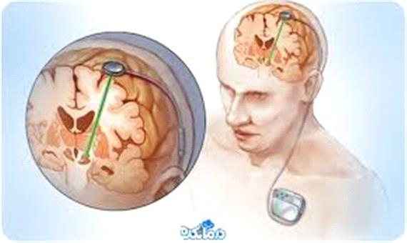 شاید آغاز بیماری پارکینسون از مغز نباشد!