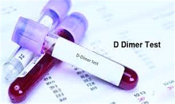 انجام تست دی-دایمر خون برای جلوگیری از آمبولی در مبتلایان به کرونا