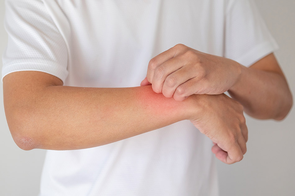 عواملی که باعث اگزمای پوستی می‌شود