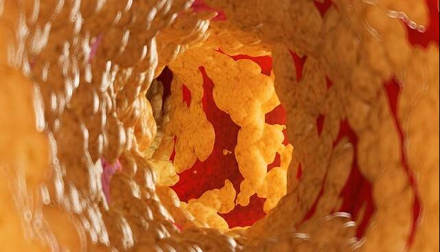 کاهش ۵۸ درصدی کلسترول بد با یک داروی جدید