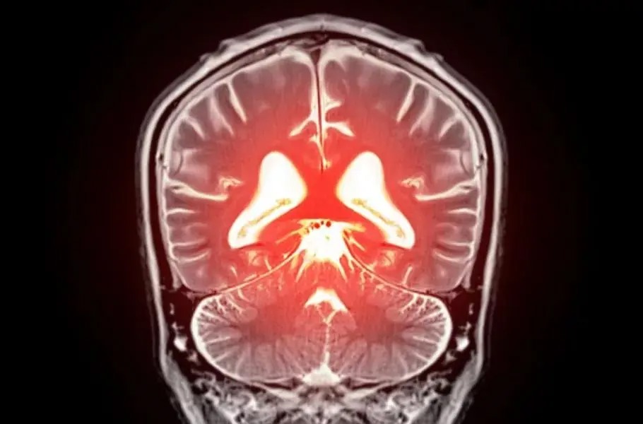 کشف امیدوارکننده برای درمان زوال عقل: کنترل یک پروتئین خاص می‌تواند فشار خون مغز را اصلاح کند