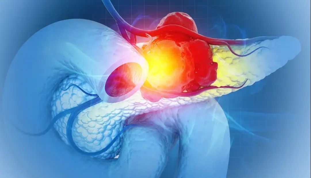 امید تازه برای درمان مقاوم‌ترین سرطان؛ دانشمندان تومورهای پانکراس را در موش‌ها نابود کردند