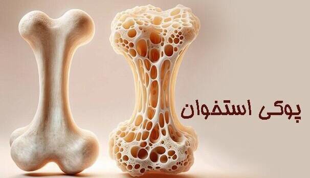 ۳۰ درصد افراد بالای ۵۰ سال خراسان شمالی به پوکی استخوان مبتلا هستند
